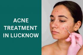 Expert Acne & Acne Scar Treatment in Lucknow