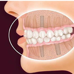 Dental Implants