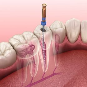 Posterior Root Canal in Dubai