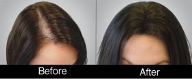 Hair Loss Treatment for Women