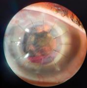 Cornea Transplant / Keratoplasty