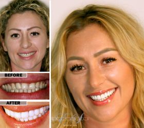 Zoom Whitening in Brooklyn	