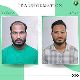 FUT Hair Transplant