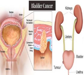 Bladder Cancer Specialist/Surgeon in Navi Mumbai