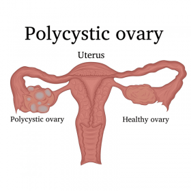 PCOS / PCOD Management