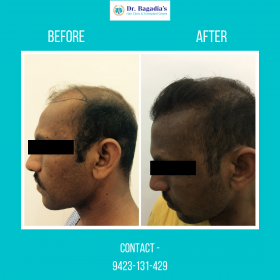 Hair Transplant in Nagpur