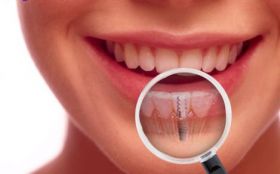 Dental Implant Treatment