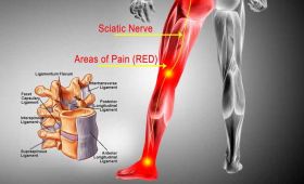 Sciatica Pain