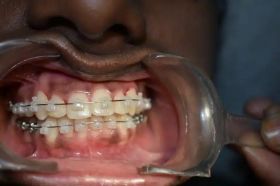 Braces