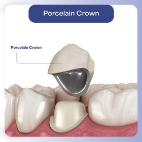 Porcelain Crowns in Hackensack, NJ