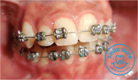 Metal Braces for teeth