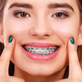 Metal Braces in Dubai