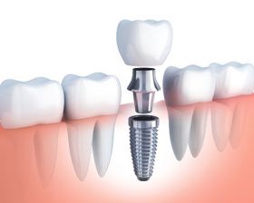 Implant Dentistry