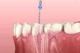 Root Canal Treatment