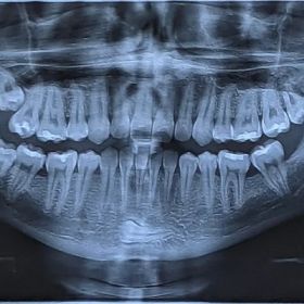 Dental Panoramic X-Ray in Dubai