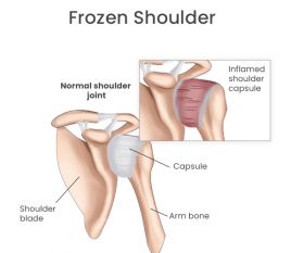 Frozen shoulder treatment - Paramus, NJ