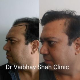 Hair Transplant in Mumbai