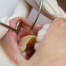 Gum Tissue Removal in Dubai