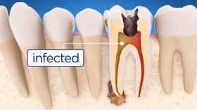 Root Canal Treatment Services in Dubai