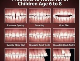 Tooth Alignment