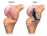 Joint Replacement Center