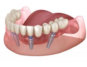 Full Mouth Rehabilitation