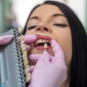 E-Max Veneers in Dubai