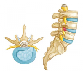 Top Herniated Disc Treatment Specialists - Bronx