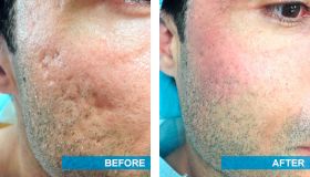 Acne Scar Removal