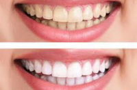 Best Teeth Whitening In Chennai | Denteazeedental