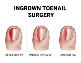 Ingrown Toenail Treatments - Wayne, NJ