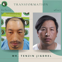 Hair Loss Treatment