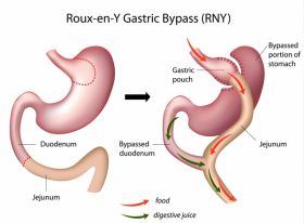 Bariatric Surgeon in Jaipur