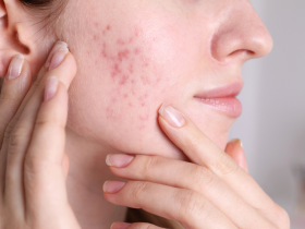 Acne Treatment in Pune