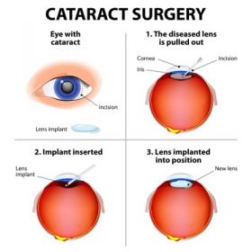 Laser Cataract Surgery