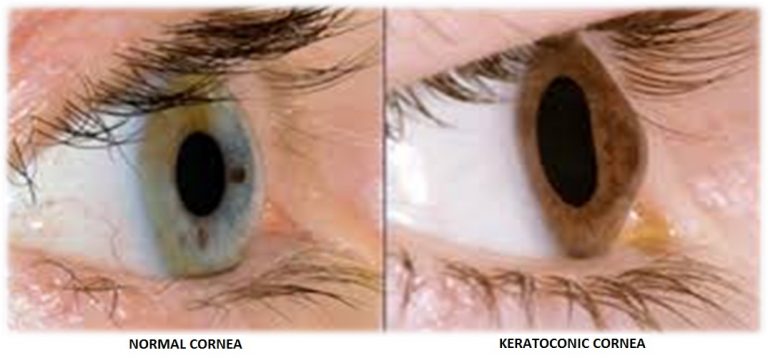 Keratoconus Eye Treatment - The Eye Foundation