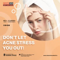 Laser Treatment For Birthmark Removal In India