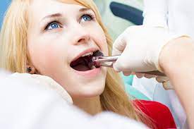 Wisdom Teeth Extraction Houston TX