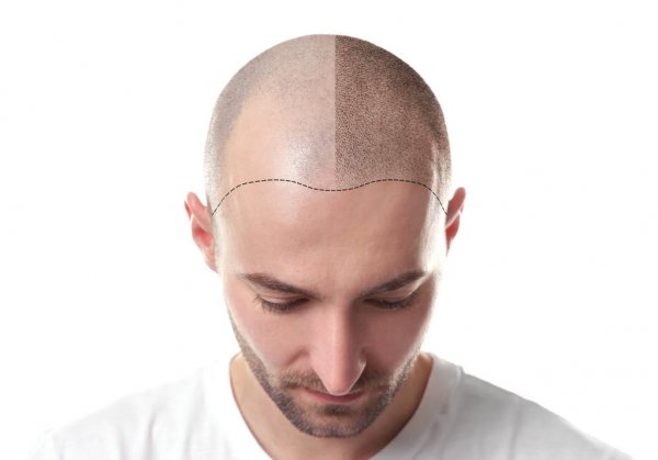Hair Transplant in Delhi | Dr. Lokesh Handa - Med Esthetiks