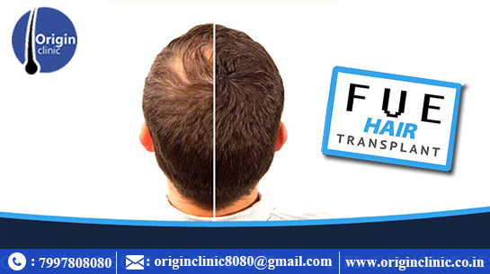 Hair Transplantation | Best Hair Transplant Doctors | Hair Transplantation in Hyderabad