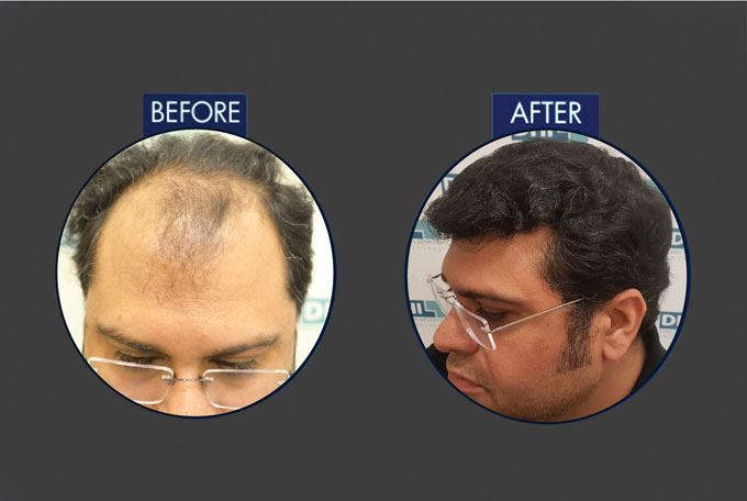Check Hair Transplant Reviews Before Finalizing Treatment