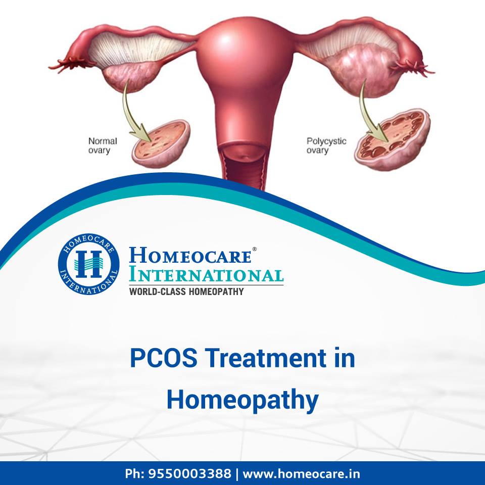 PCOS Treatment In Homeopathy