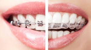 Best Dental Crown in Houston, TX