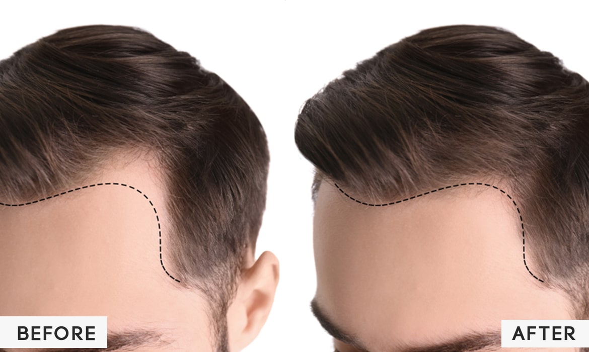 Hair Loss Treatment in Noida