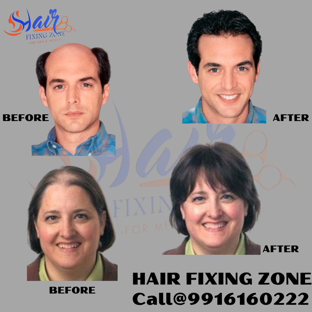 Non Surgical Hair Replacement Services