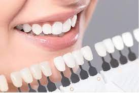 Dental Veneers Houston, TX