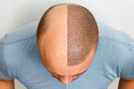 Hair transplantation in Riyadh