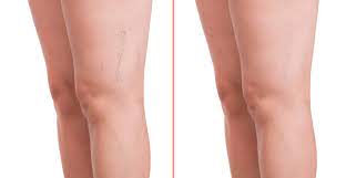 Vein Treatment Near Me