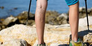 Vein Treatments in California