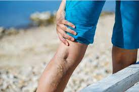 NJ Vein Treatment Near Me